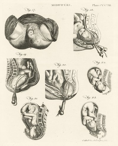 Midwifery, illustration from 